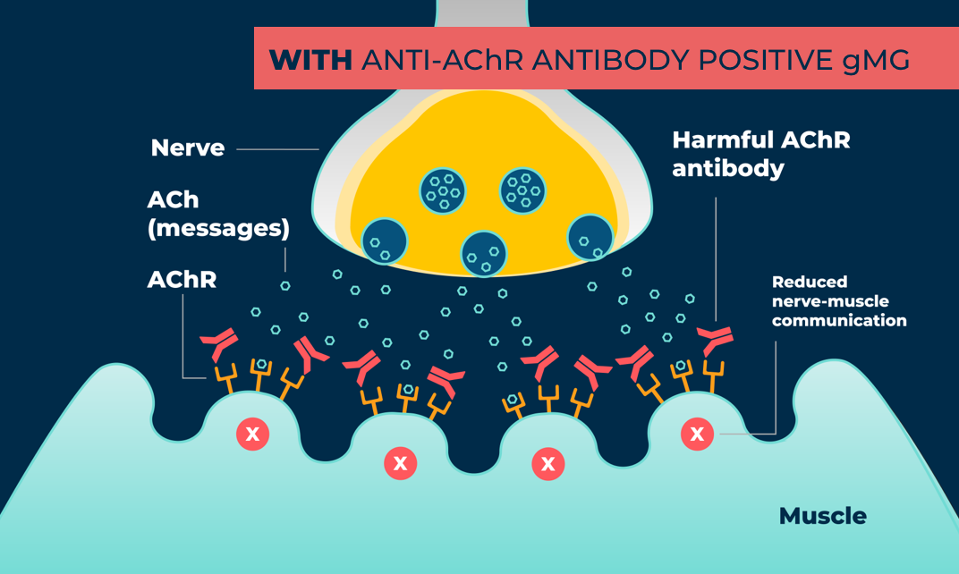 With gMG, harmful AChR antibodies may stop muscles from getting some messages sent by nerves, leading to reduced muscle movement .