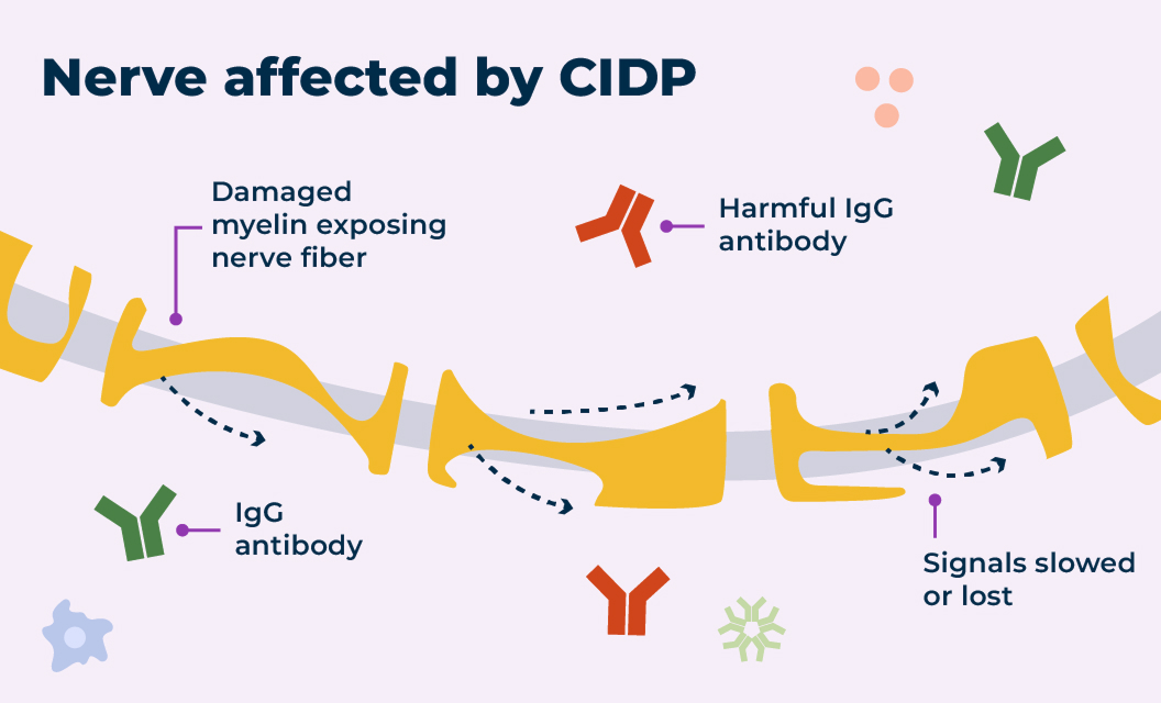 For some people with CIDP, harmful IgG antibodies that remain in the body too long can cause damage to the protective later around the nerve called myelin.